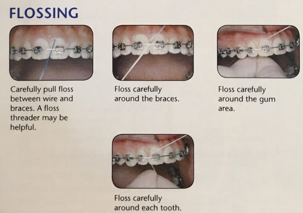 Techniques for Flossing