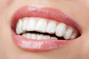 tips for Invisalign | Invisalign tips | tips for clear aligners