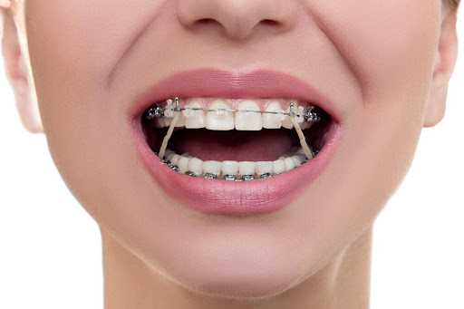 Orthodontic Elastics