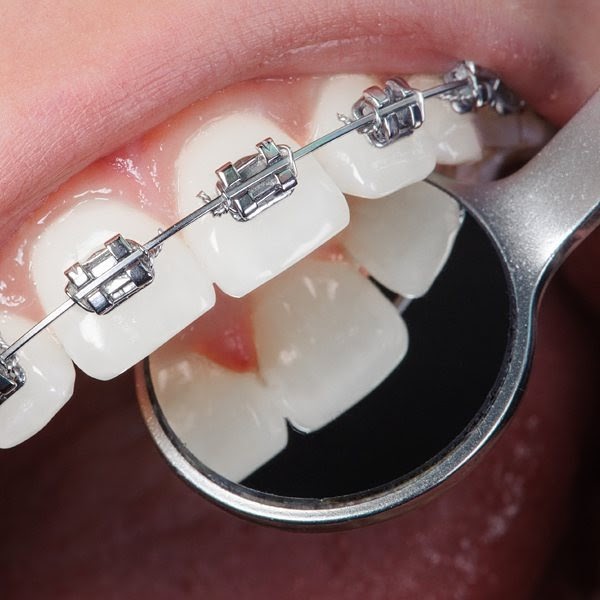 Adult Orthodontic Procedures Image