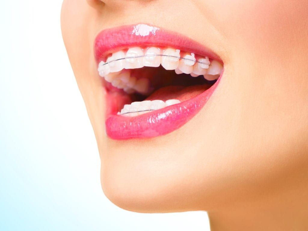 Clear Braces Orthodontics Treatments