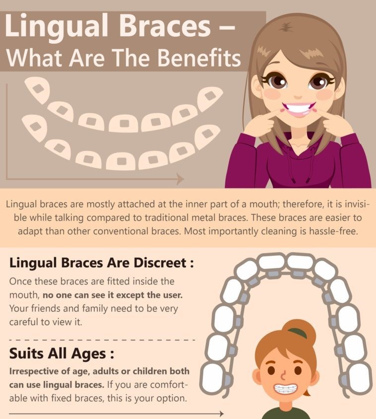 Benefits Of Lingual Braces