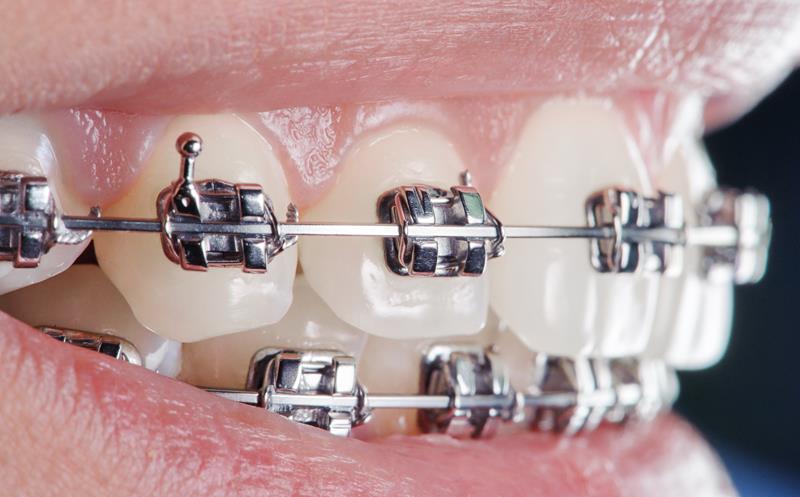 Traditional Braces Treatments
