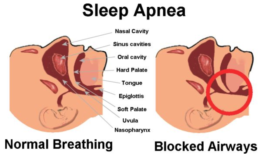 What Is SLEEP APNEA?