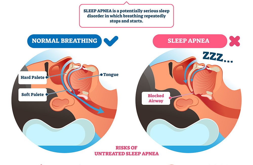 Risk of sleep apnea image