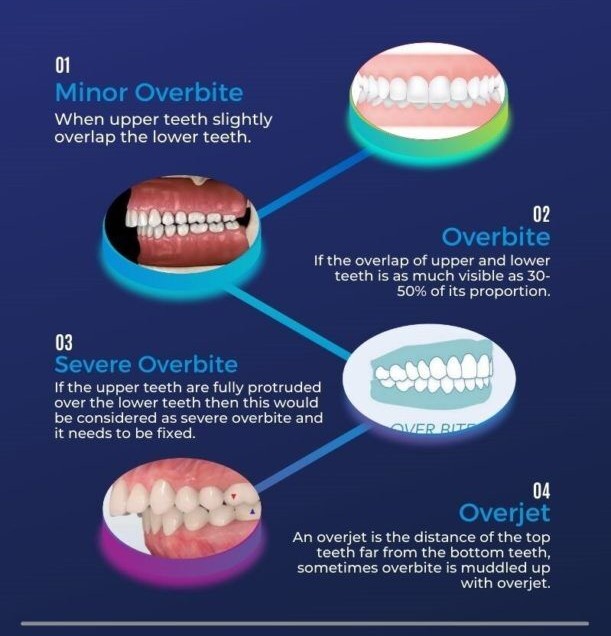 Overbite Treatment Options Image