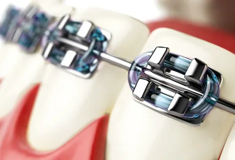 Traditional Braces Dentistry