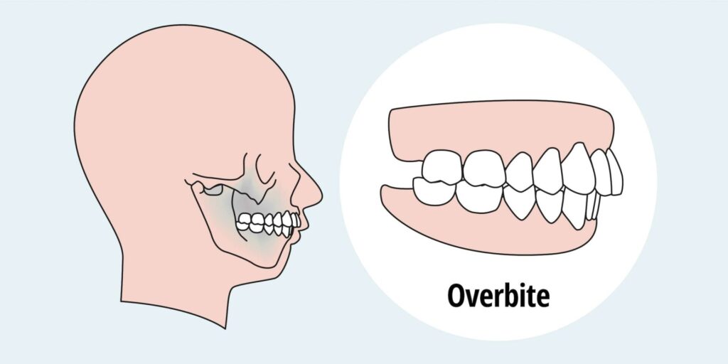 What is an Overbite​ image