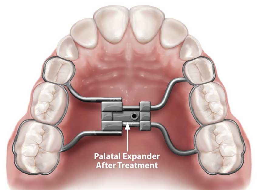 Benefits of Palatal Expander Treatments​
