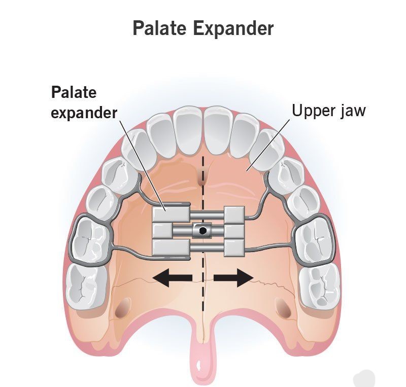 Palatal Expander Treatments Image