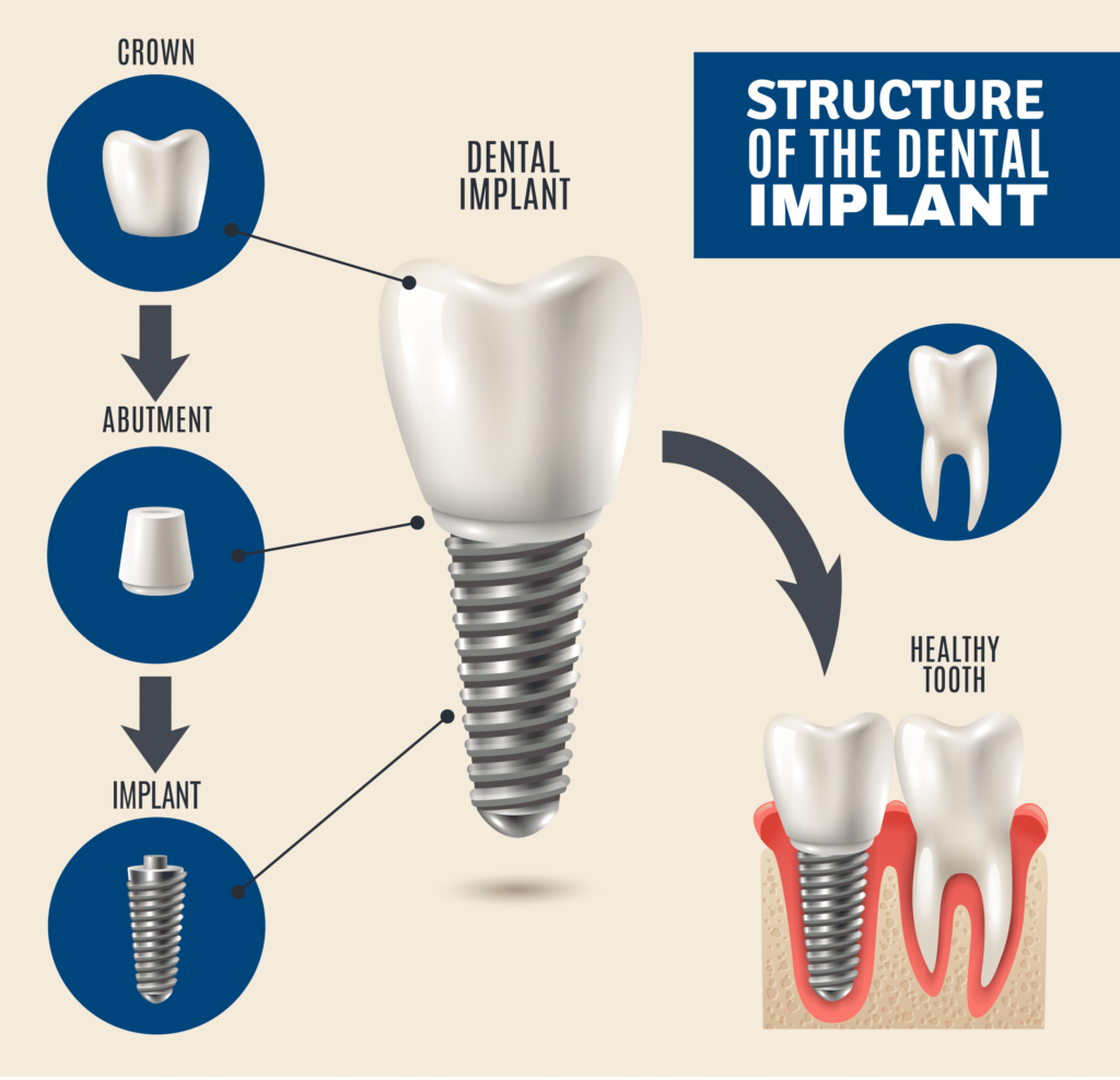 Dental Implant Setup Treatment