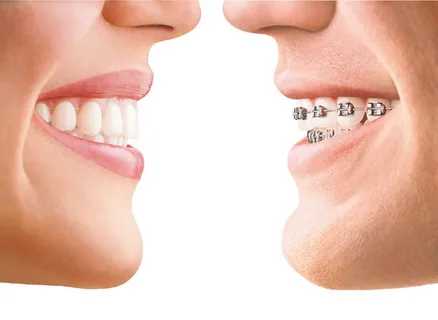Cosmetic Orthodontics Treatment