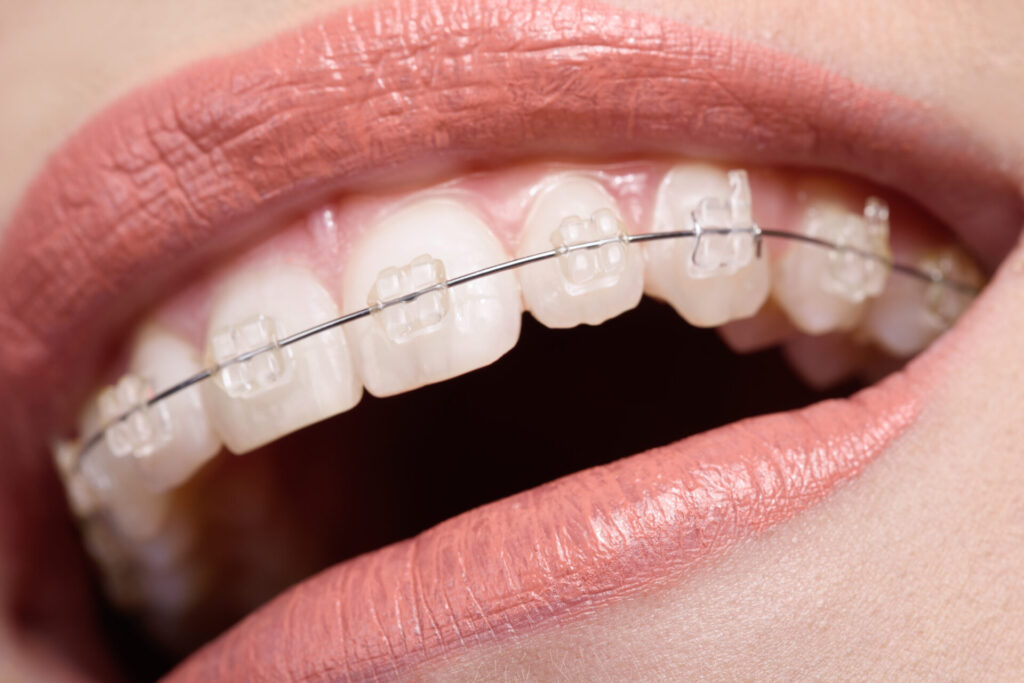 Personalized Clear Braces