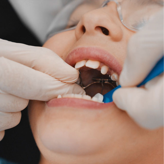 Palatal Expander Orthodontics Treatment Image