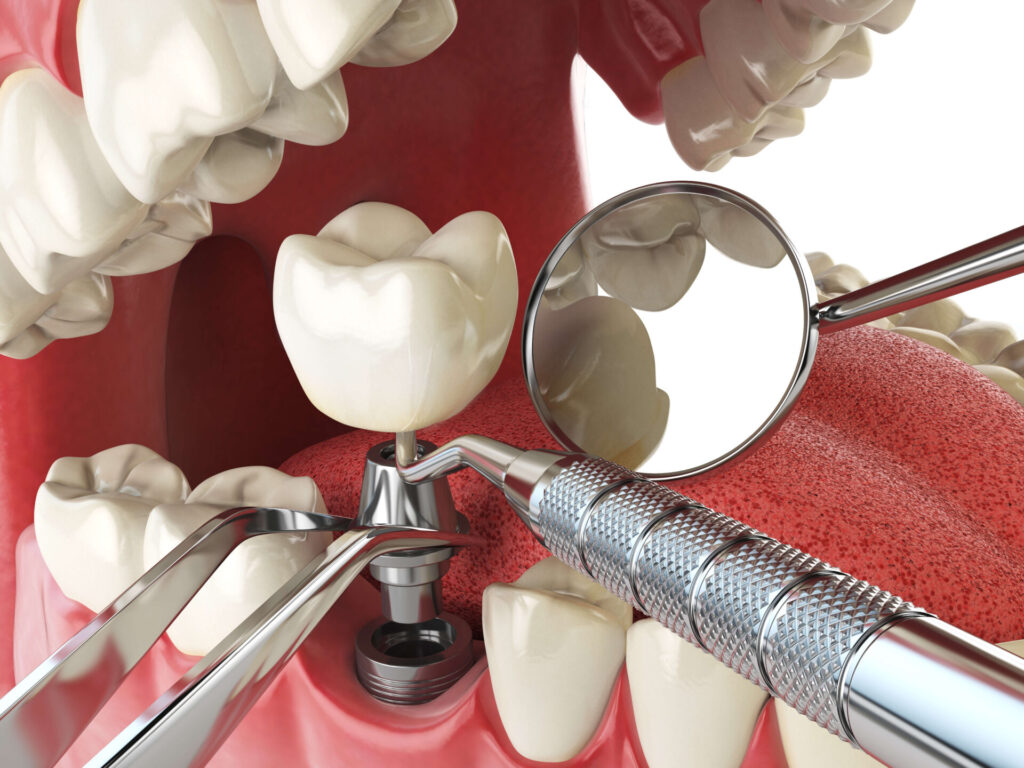 Dental Implant Setup treatments